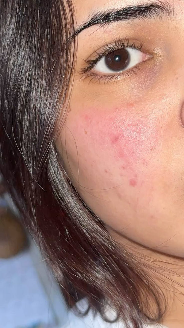 Antes